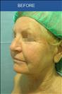 Facelift - Cirumed Clinic