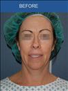 Facelift - Cirumed Clinic