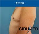 Gynecomasty - Cirumed Clinic