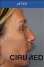Rhinoplasty - Cirumed Clinic