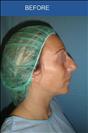 Rhinoplasty - Cirumed Clinic