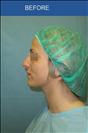 Rhinoplasty - Cirumed Clinic