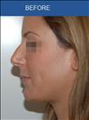 Rhinoplasty - Cirumed Clinic