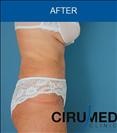 Abdominoplasty - Cirumed Clinic