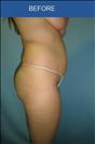 Abdominoplasty - Cirumed Clinic