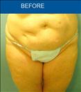 Abdominoplasty - Cirumed Clinic