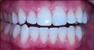 Teeth Whitening - Herzliya Dental Clinic