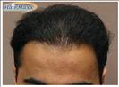 Hair Transplant - Hairmaxx