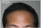Hair Transplant - Hairmaxx