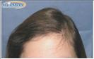 Hair Transplant - Hairmaxx