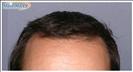 Hair Transplant - Hairmaxx