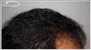 Hair Transplant - Hairmaxx