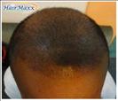 Hair Transplant - Hairmaxx