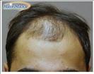 Hair Transplant - Hairmaxx