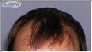 Hair Transplant - Hairmaxx