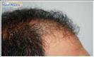 Hair Transplant - Hairmaxx
