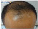Hair Transplant - Hairmaxx
