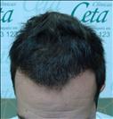 FUE transplant - 2,000 grafts - Clinica CETA