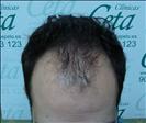 FUE transplant - 2,000 grafts - Clinica CETA