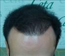 FUE transplant - 3,750 grafts - Clinica CETA