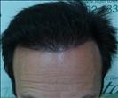 FUE transplant - 2,900 grafts - Clinica CETA