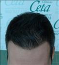 FUE transplant - 800 grafts - Clinica CETA