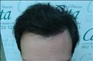 FUE transplant - 2,500 grafts - Clinica CETA