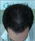 FUE transplant - 2,000 grafts - Clinica CETA