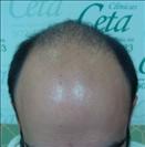 FUE transplant - 3,750 grafts - Clinica CETA