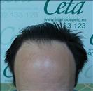 FUE transplant - 2,900 grafts - Clinica CETA