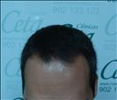 FUE transplant - 800 grafts - Clinica CETA