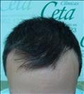 FUE transplant - 2,500 grafts - Clinica CETA