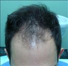 FUE transplant - 2,000 grafts - Clinica CETA