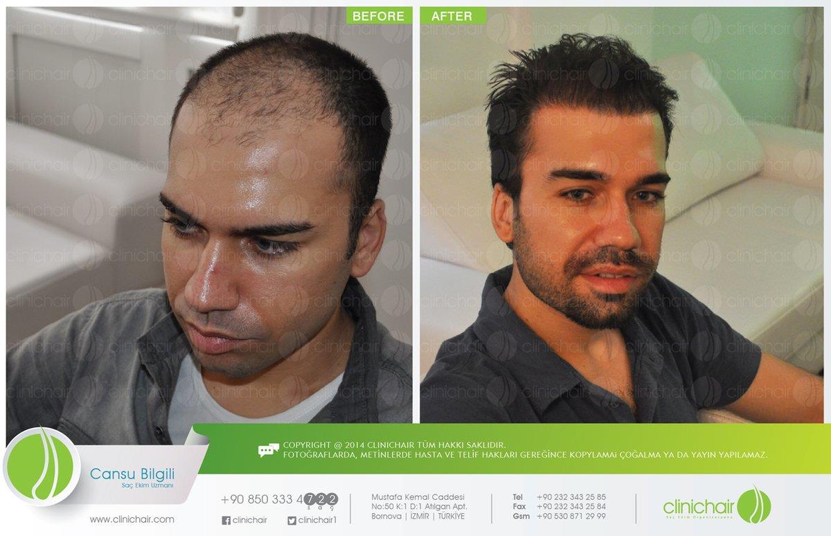 Clinichair Hair Transplant Center