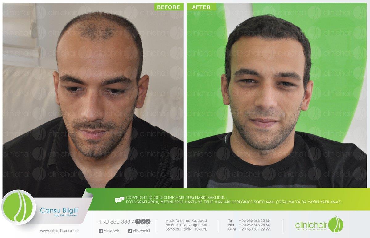 Clinichair Hair Transplant Center