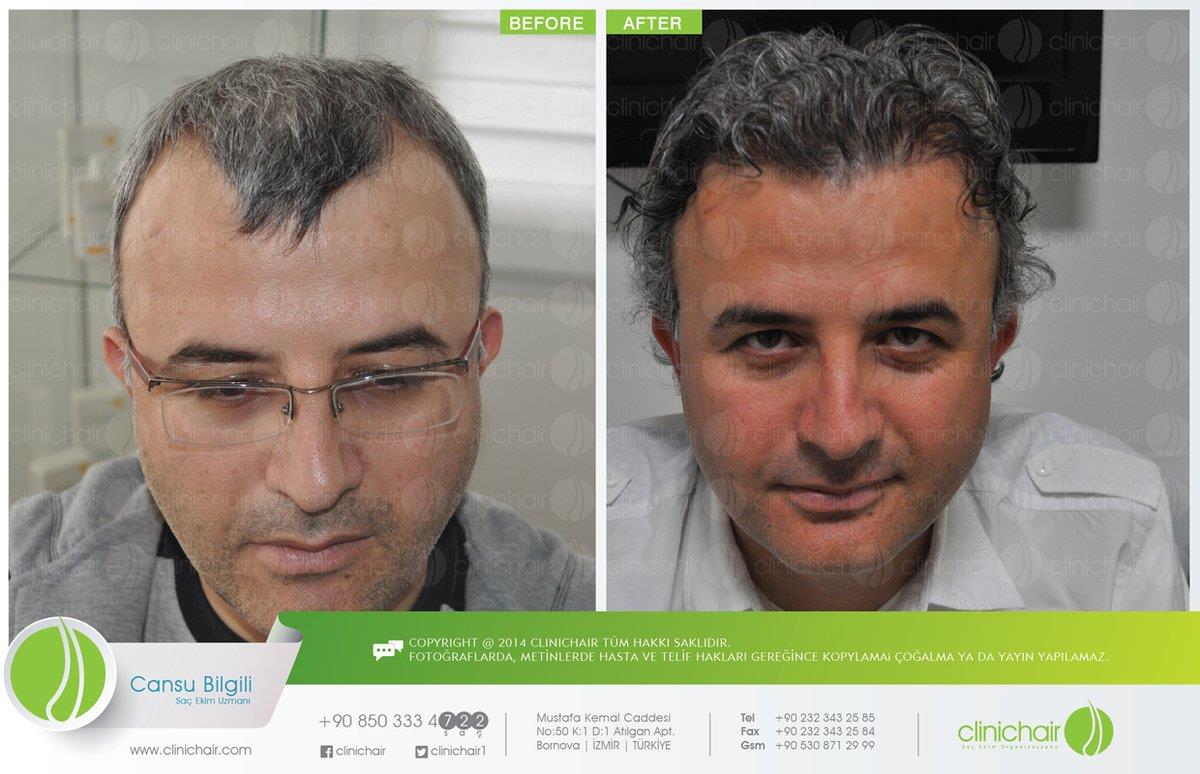 Clinichair Hair Transplant Center