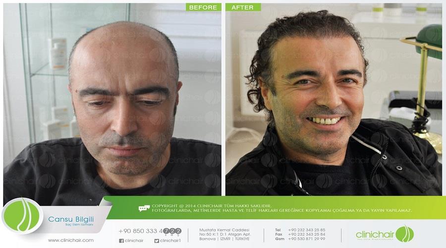 Clinichair Hair Transplant Center