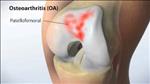 Knee replacement by MAKOplasty®