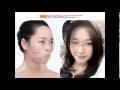Before & After Plastic Surgery At Banobagi