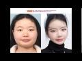 Plastic Surgery Before & After