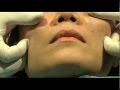 The Liquid Facelift using Juvederm Voluma