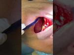 Video implant
