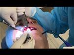 Video opening of the sinus lift