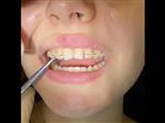 Video orthodontic appliances
