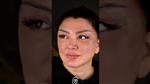 (in German) Patient Shorts Neriman Endoscopic Temporal Lift and Cat Eye Surgery (Canthoplasty )