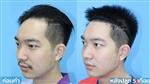 รีวิว ปลูกผม FUE 5 เดือน ที่ #DHTHairClinic โดยแพทย์และพยาบาลประสบการณ์กว่า 25 ปี | Patient's review