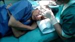 FUE hair transplant procedure - part 1