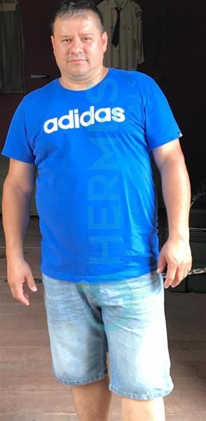 Gastric Sleeve Surgery