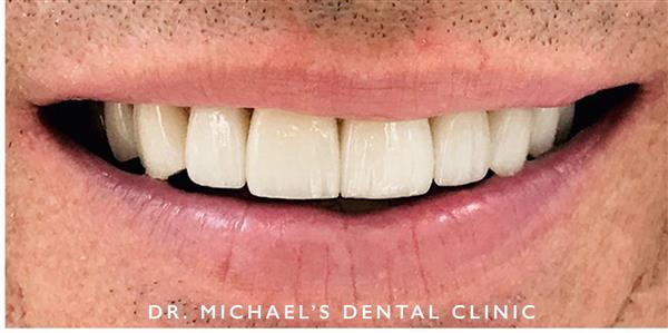 Dental Veneers