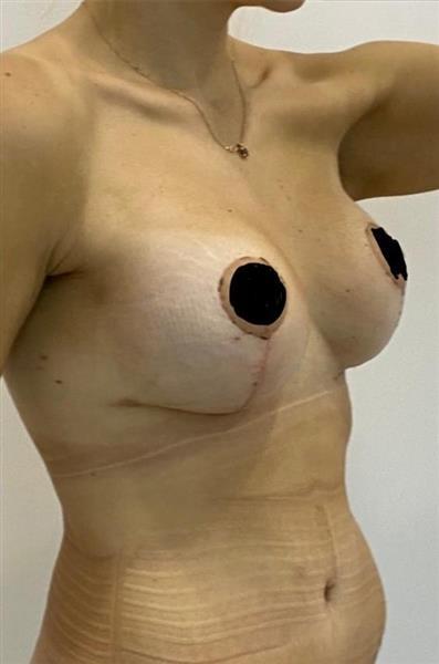 Breast Lift